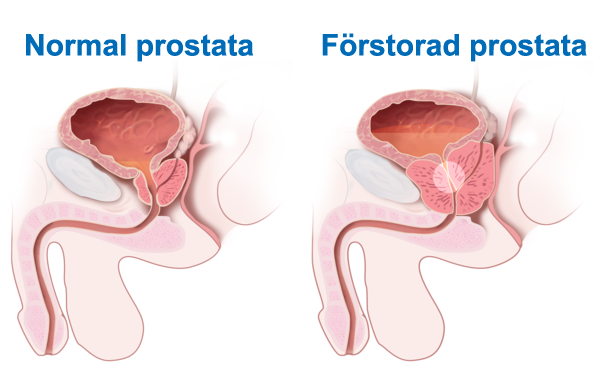 wellspect-fragor-och-svar-om-godartad-prostataforstoring.png